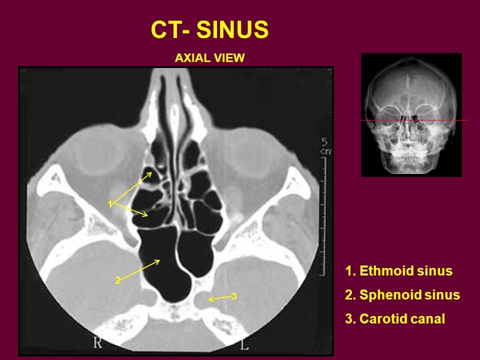 CT-_SINUS_1__Ethmoid_sinus_2__Sphenoid_sinus_3__Carotid_canal.jpg