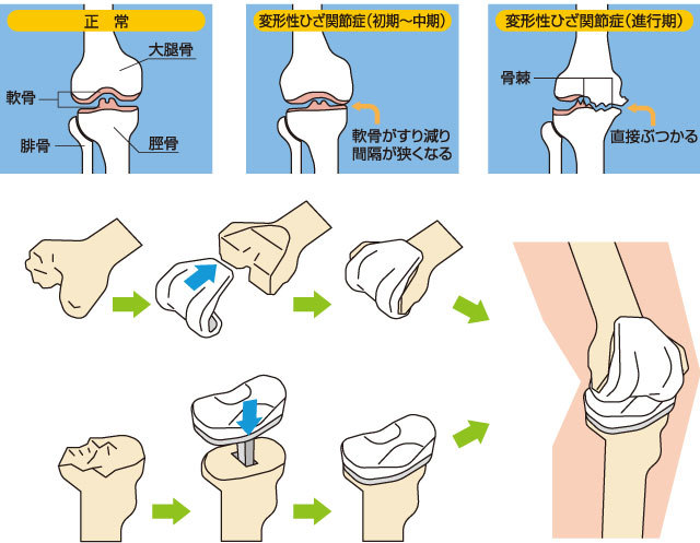 変形性膝関節症2